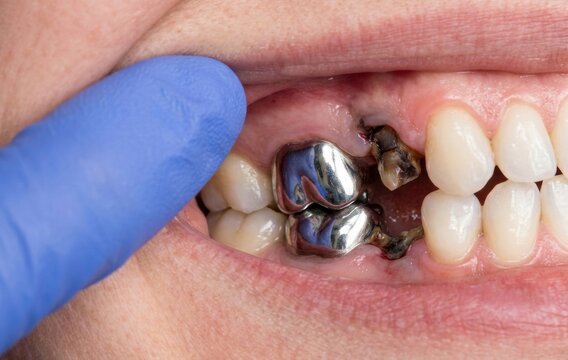 Professional examination of decayed teeth with silver metal fillings by a dentist in a clinic dentistry examination