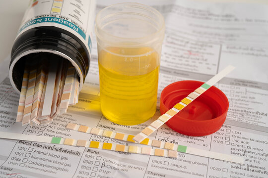 Urinalysis, urine cup with reagent strip pH paper test and comparison chart in laboratory.