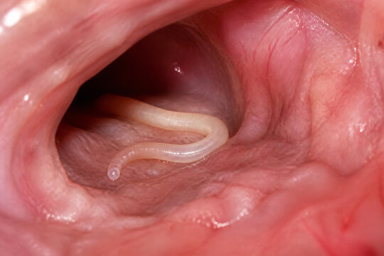 A small, pale worm is visible inside a human throat or esophagus.