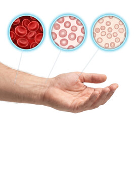 Red blood cell anemia progression comparison, healthy and abnormal blood cells showing reduced hemoglobin and blood health medical concept