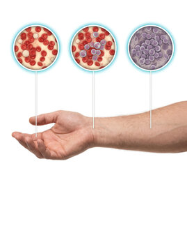 Abnormal blood cells and blood disorder progression concept, microscopic blood cell changes hematology disease and medical illustration