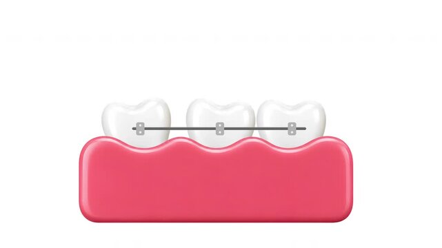 Dental teeth Braces Animation with Orthodontic Treatment Concept on White Background