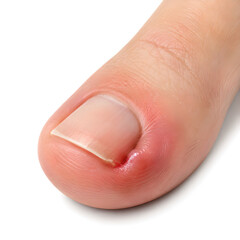 Fototapeta premium Ingrown toenail medical 3D anatomy render showing inflamed big toe nail margin with redness and swelling, isolated on white background for healthcare, podiatry, medical education and patient education