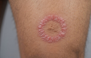 Fototapeta premium Ringworm Tinea Corporis Fungal Infection Red Scaly Rash on Skin