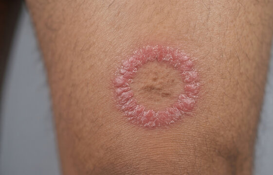 Ringworm Tinea Corporis Fungal Infection Red Scaly Rash on Skin