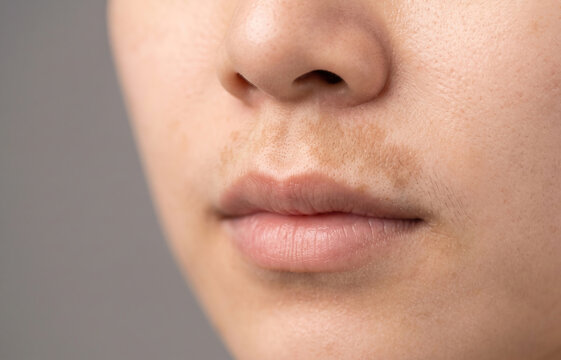 Hyperpigmentation melasma chloasma dark patches on the upper lip and philtrum skin of Asian female