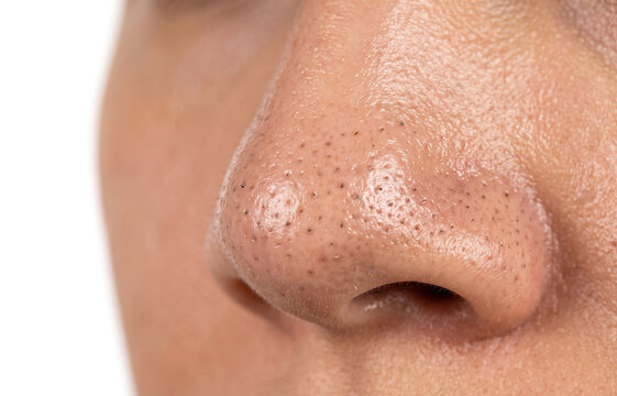 Close up of multiple open comedones blackheads and enlarged pores on oily human nose skin surface
