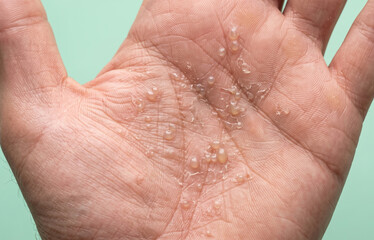 Fototapeta premium Dyshidrotic Eczema Pompholyx Blisters on Human Palm Skin Close Up