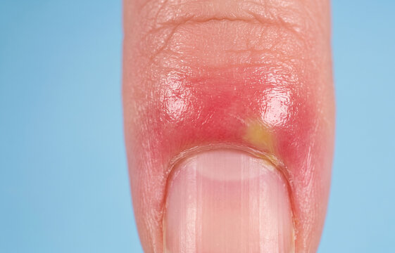 Close up of acute paronychia with painful yellow pus abscess and erythema on inflamed finger nail bed