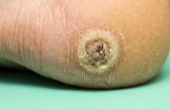 Macro Detail of Plantar Wart Verruca Plantaris on Foot Heel