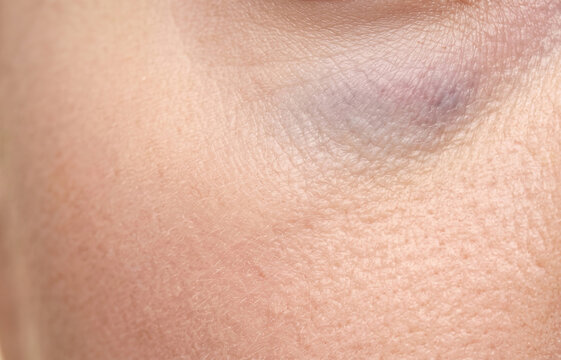 Macro shot of a faint purple bruise ecchymosis or minor subcutaneous hematoma on human cheek skin