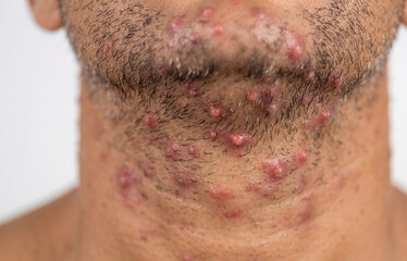 Fototapeta premium Close up of active pseudofolliculitis barbae razor bumps and inflamed pustules on caucasian male neck