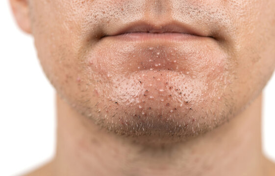 Multiple closed comedones whiteheads and early folliculitis papules on male chin shaving area
