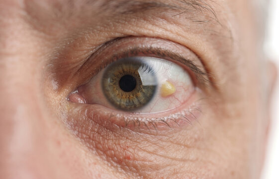 Macro Close Up of Pinguecula Yellow Bump on Conjunctiva of Senior Eye