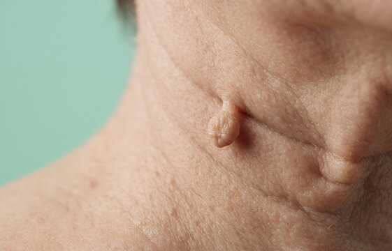 Macro Close Up of Skin Tag Acrochordon on Mature Woman Neck