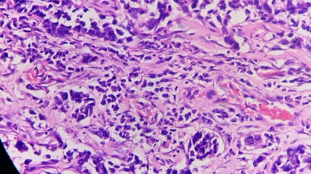 Histopathology of right breast lump. HPE: Infiltrating ductal carcinoma (NST), bloom-richardson nuclear grade-II. Negative Estrogen receptor, Progesterone receptor, HER-2.