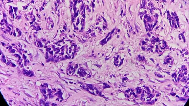 Histopathology of right breast lump. HPE: Infiltrating ductal carcinoma (NST), bloom-richardson nuclear grade-II. Negative Estrogen receptor, Progesterone receptor, HER-2.