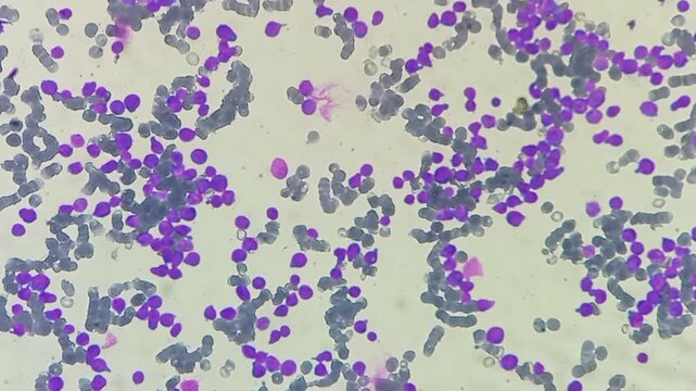 Acute lymphoblastic leukaemia (ALL). Blast cells 90%, neutrophils, lymphocytes, monocytes, eosinophils and reduced platelets count. 