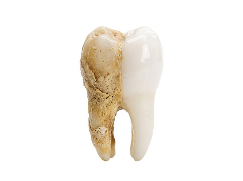 Dental tooth decay plaque clean split molar showing dirty calculus tartar vs healthy white enamel restoration treatment isolated on black background for dentistry medical hygiene concept education.