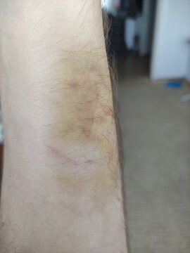 Healing bruise with yellow and red discoloration on hairy human arm close up