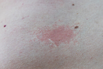 Fototapeta premium Close-up of red skin rash or allergy on abdomen, dermatitis, skin irritation, healthcare.