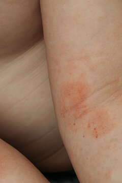 Close-up of a child's arm with red, irritated skin from dermatitis.