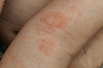 Fototapeta premium Macro detail of red, inflamed skin rash on a child's arm.