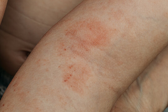 Macro detail of red, inflamed skin rash on a child's arm.