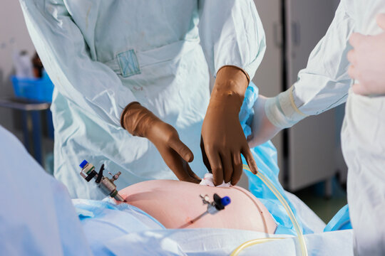 Surgeon is treating sites where laparoscopic trocars are inserted into abdominal cavity with gauze. Yellow drainage tubes are visible. Metal trocars have been inserted into patients skin