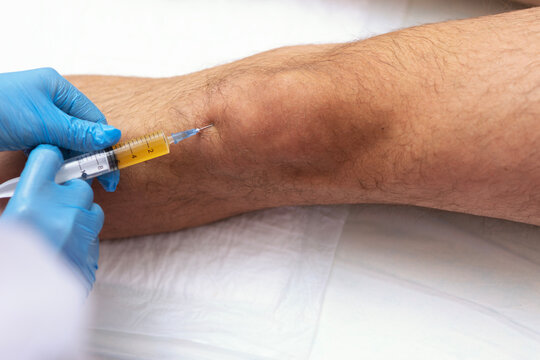 Intraarticular injection of platelet-rich plasma (PRP therapy) into patient's knee for joint treatment in an orthopedic clinic. Plasma therapy procedure in orthopedic clinicown biomaterial