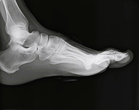 Lateral and AP view X-ray scan of human foot and ankle showing tarsal bones and phalanges