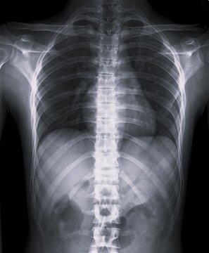 Frontal AP X-Ray Radiograph of Thoracic Spine Showing Dorsal Vertebrae and Rib Cage Anatomy