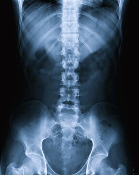 Frontal AP view X-ray scan of human lumbar spine sacrum and pelvic bones