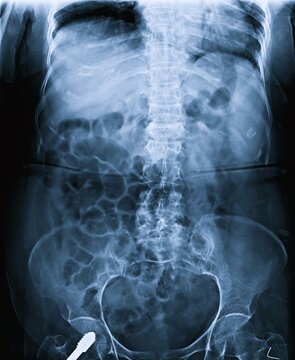 Frontal AP view pelvis X-ray scan displaying hip joints and iliac bone structure