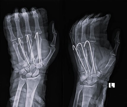 Hand X-ray scan displaying metacarpal fracture surgical Kirschner wire K-wire fixation