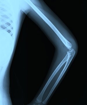 AP and lateral elbow joint X-ray scan showing humerus radius and ulna articulation
