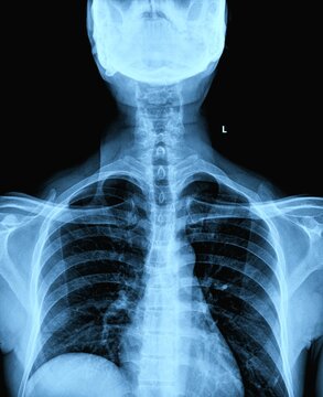Cervical spine X-ray radiograph AP and lateral view showing neck vertebrae anatomy