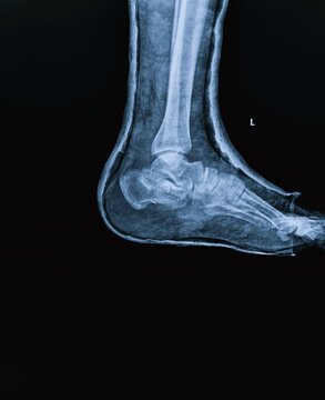 Lateral view X-ray scan of human ankle joint and calcaneus heel bone anatomy