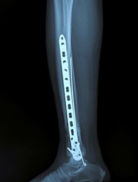Lateral radiography of tibia and fibula showing surgical metal plate and screws fixation