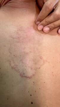 Slow motion vertical close up of a hand scratching a large, red, itchy ringworm rash on a person's back. The skin shows a severe fungal infection, allergy, or dermatitis causing discomfort.