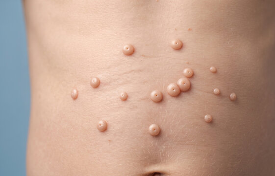 Close up of molluscum contagiosum viral skin infection papules on child abdomen