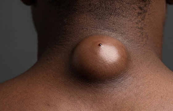 Macro view of a large epidermoid cyst or sebaceous cyst on dark skin neck