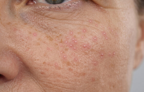 Close up of multiple milia keratin cysts and whiteheads on human cheek skin