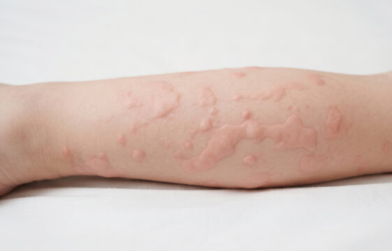 Macro view of severe urticaria hives rash and itchy raised wheals on human arm