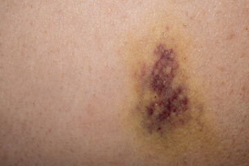 Fototapeta premium Close Up of a Bruised Skin Area. Skin Hematoma with Purple and Blue Discoloration. Visible Bruising on Human Skin.