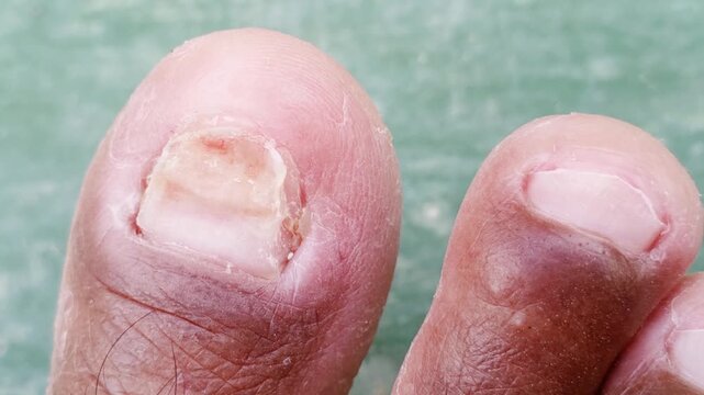 The nail exhibits yellowish discoloration, a rough and brittle texture, and a partial separation from the bed with surrounding redness.