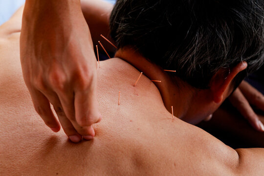 Acupuncture session to relieve pain in the shoulder and back