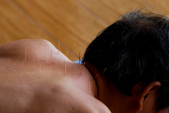 Acupuncture session to relieve pain in the shoulder and back