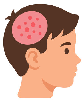 Child with ringworm fungal infection on scalp