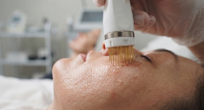 Close-up shot of a professional RF microneedling skin rejuvenation treatment being performed 